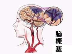 養成好的生活習慣，能夠有效預防腦梗塞